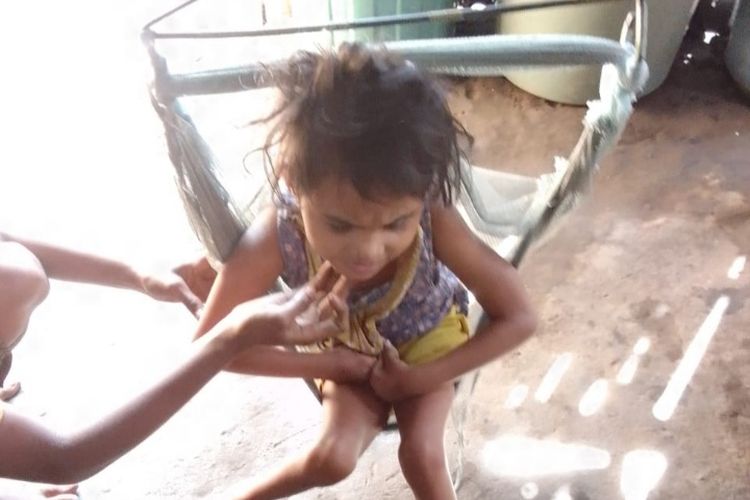 Foto: Gustina Yunita Widin (7) bocah asal Dusun Podor, Desa Boru, Kecamatan Wulanggitang, Kabupaten Flores Timur, NTT mengalami cacat dan buta mata sejak lahir