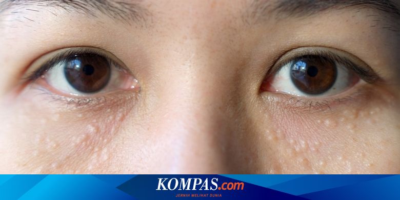 Apakah penggunaan lapisan perawatan kulit dapat menyebabkan jerawat kistik?