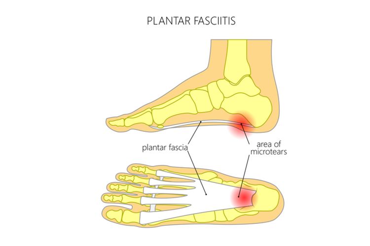 Ilustrasi plantar fasciitis