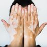 5 Penyebab Vitiligo, Penyakit Memudarnya Warna Kulit yang Baik Diantisipasi