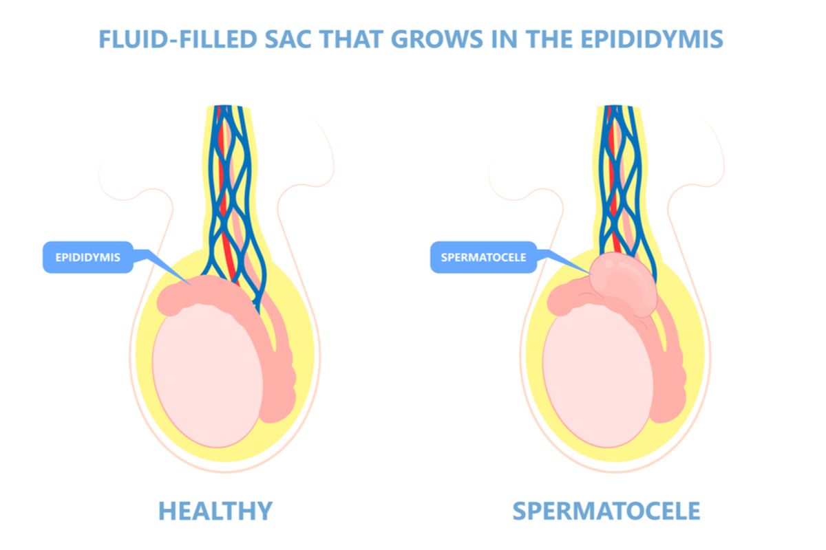 Ilustrasi spermatokel