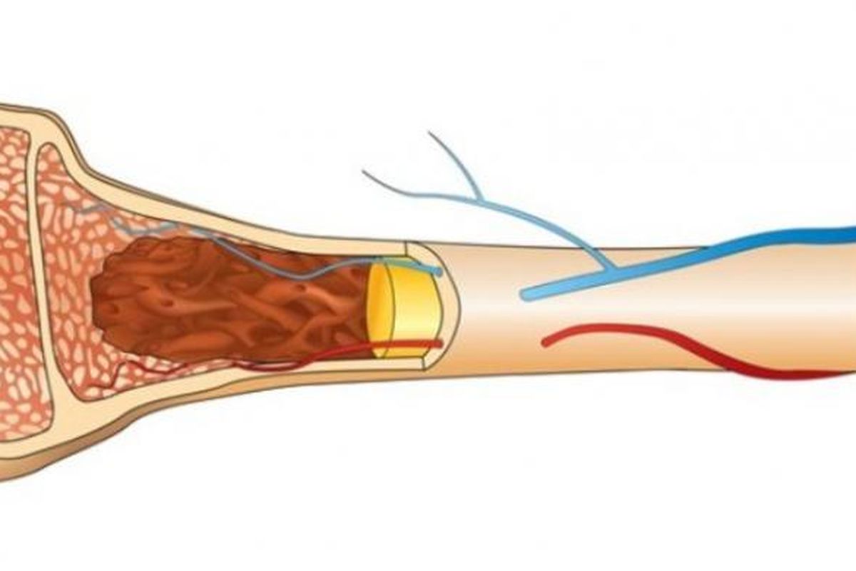 Ilustrasi tulang rapuh.