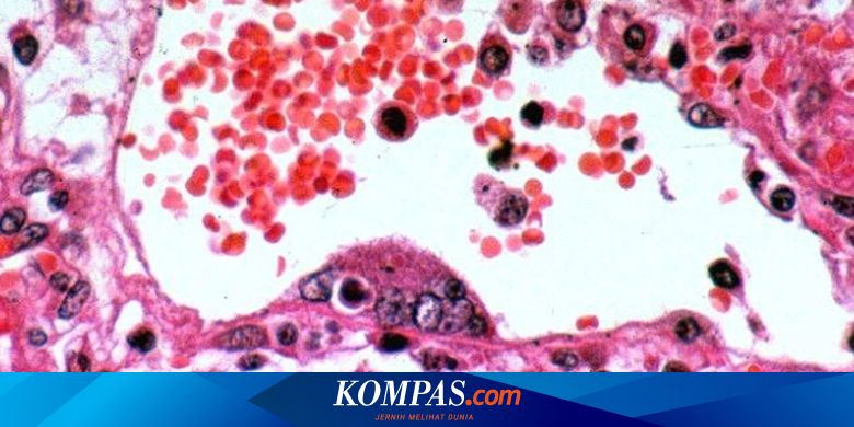 Virus Nipah: Gejala, Masa Inkubasi, Cara Penularan dan Pencegahannya