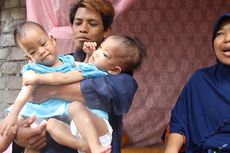 90 Dokter Terlibat dalam Operasi Pemisahan Bayi Kembar Siam Anaya dan Inaya