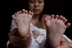 Bayi Laki-laki di China Memiliki 31 Jari Tangan dan Kaki