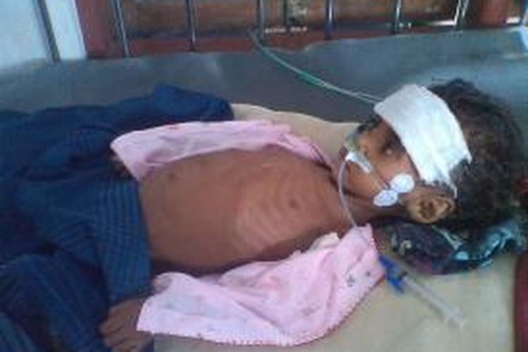 Scolastika Bana bocah berusia satu tahun asal Desa Humusu C, Kecamatan Insana Utara, Timor Tengah Utara (TTU), Nusa Tenggara Timur, yang menderita gizi buruk dirawat secara intensif di RSUD Kefamenanu.