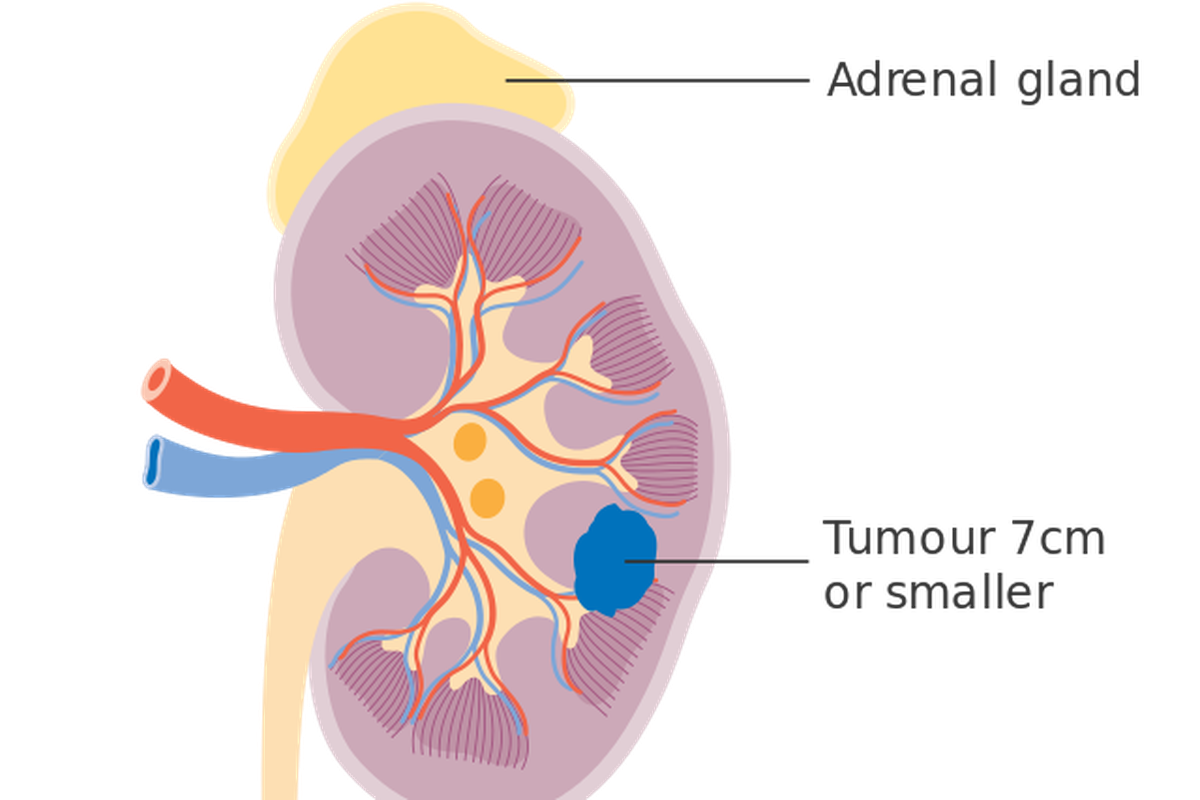 Ilustrasi kanker ginjal. Ada beberapa cara untuk mengobati penyakit ini, seperti operasi, terapi target, dan radioterapi. 