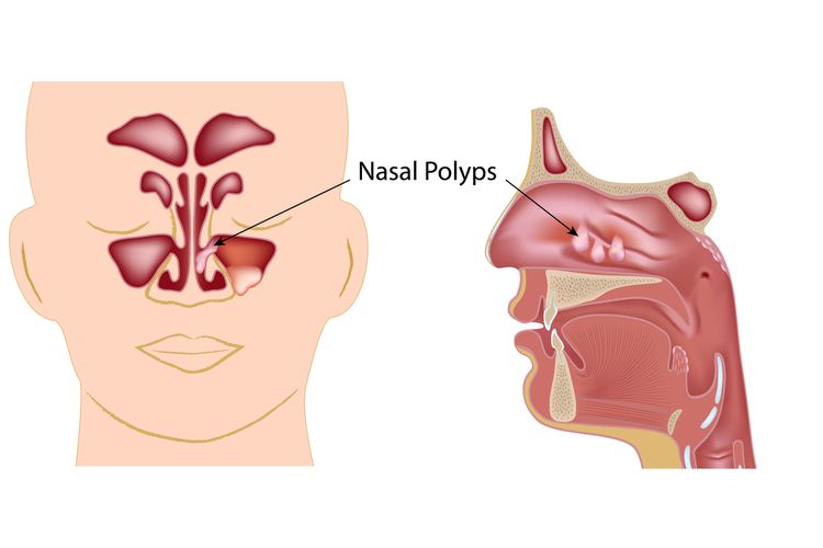Ilustrasi polip hidung