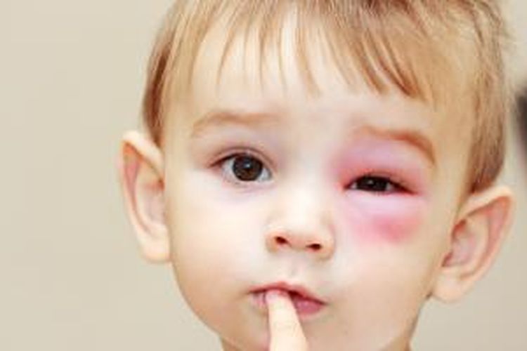 Ilustrasi alergi.
