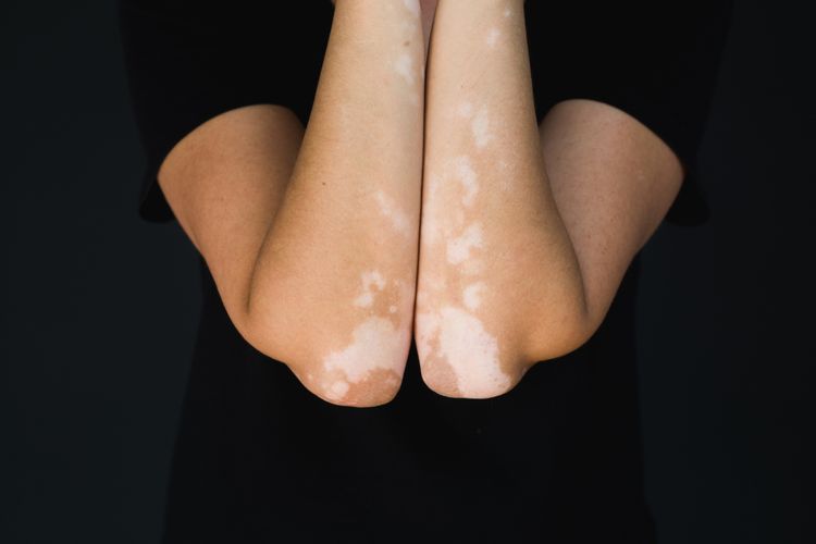 Ilustrasi vitiligo, apa itu vitiligo, penyebab vitiligo, obat vitiligo