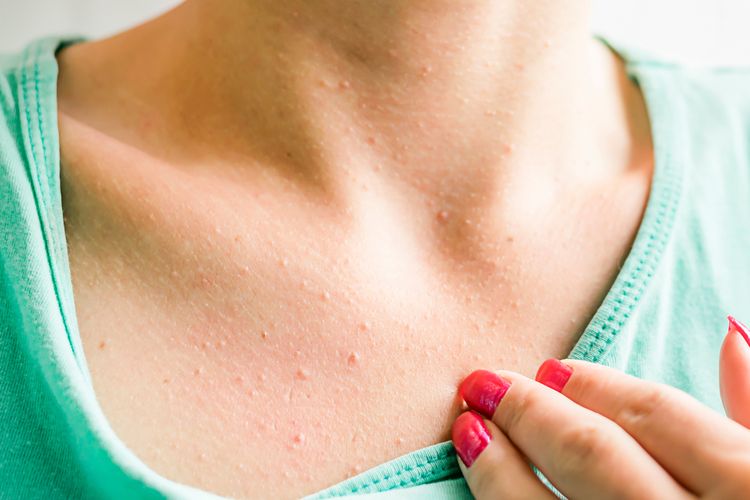 Cara menghilangkan jerawat di dada menurut dokter kulit