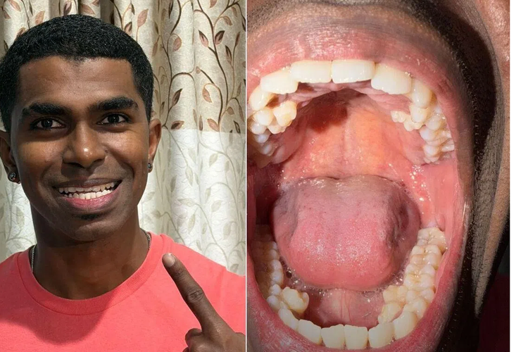 Pria Ini Punya 42 Gigi, 10 Lebih Banyak dari Jumlah Normal