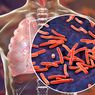 Cara Mencegah Infeksi Paru-paru yang Harus Diperhatikan
