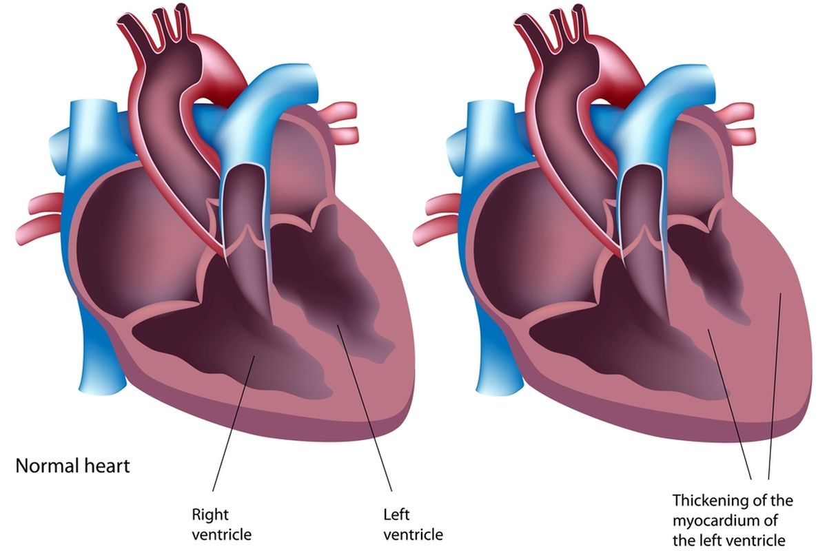 Ilustrasi Hipertrofy Ventrikel Kiri