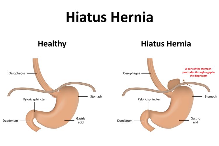 Ilustrasi hernia hiatus