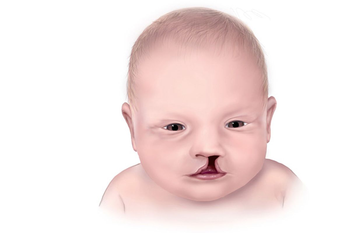 Ilustrasi anak dengan bibir sumbing. Dokter THT-KL mengatakan bahwa kelainan celah bibir dan langit-langit mulut berisiko membuat anak mengalami gangguan perkembangan mental dan fisik.