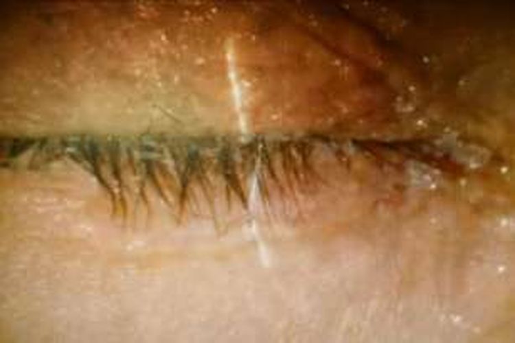 Kondisi mata Zhao Xing Nvzi setelah ditetesi cairan super glue.