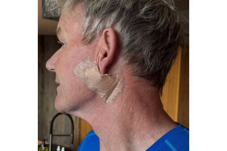 Chef Gordon Ramsay mengidap kanker kulit basal cell carcinoma (karsinoma basal sel). Apa saja gejalanya dan faktor risikonya? Simak selengkapnya.