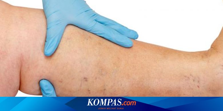 Benarkah Bisa Varises jika Tekuk Kaki Sebelum 40 Hari Pasca Melahirkan? - Vimarsana News
