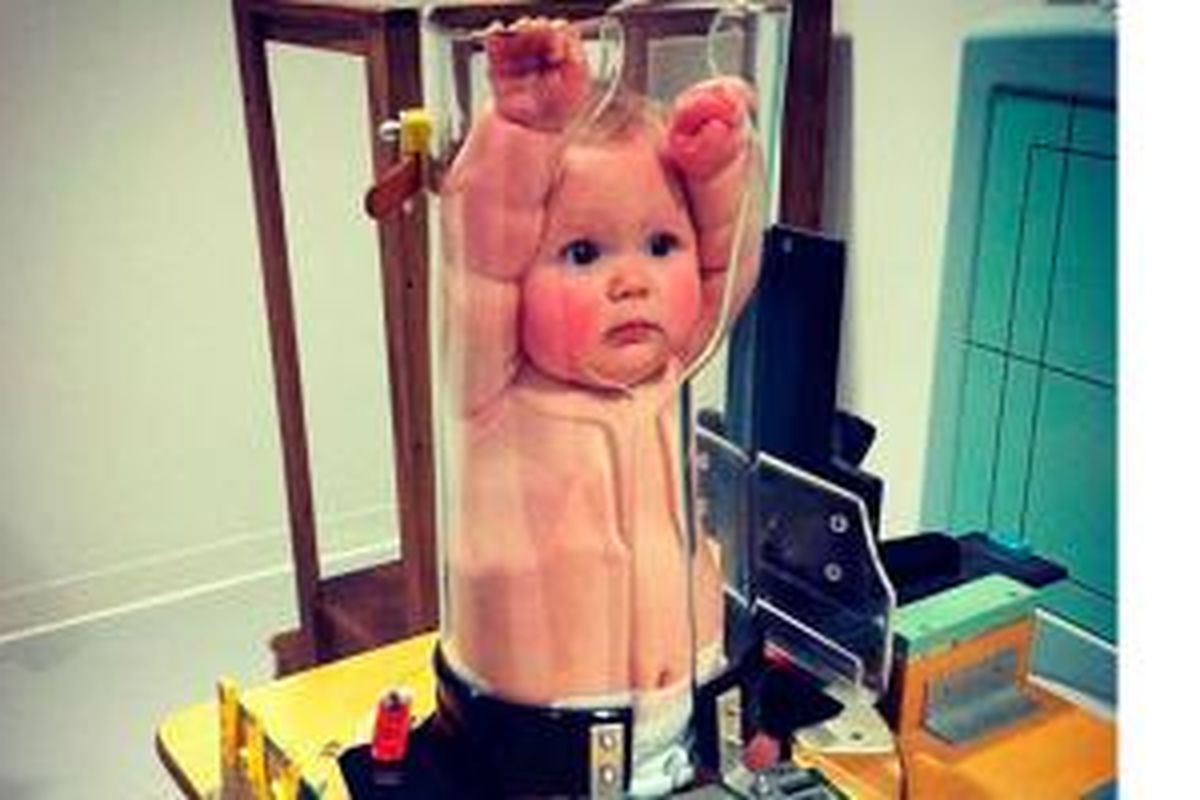 Foto bayi yang menjalani Pigg-O-Statt ini bergulir viral dan mengundang banyak komentar dari para netizen. 