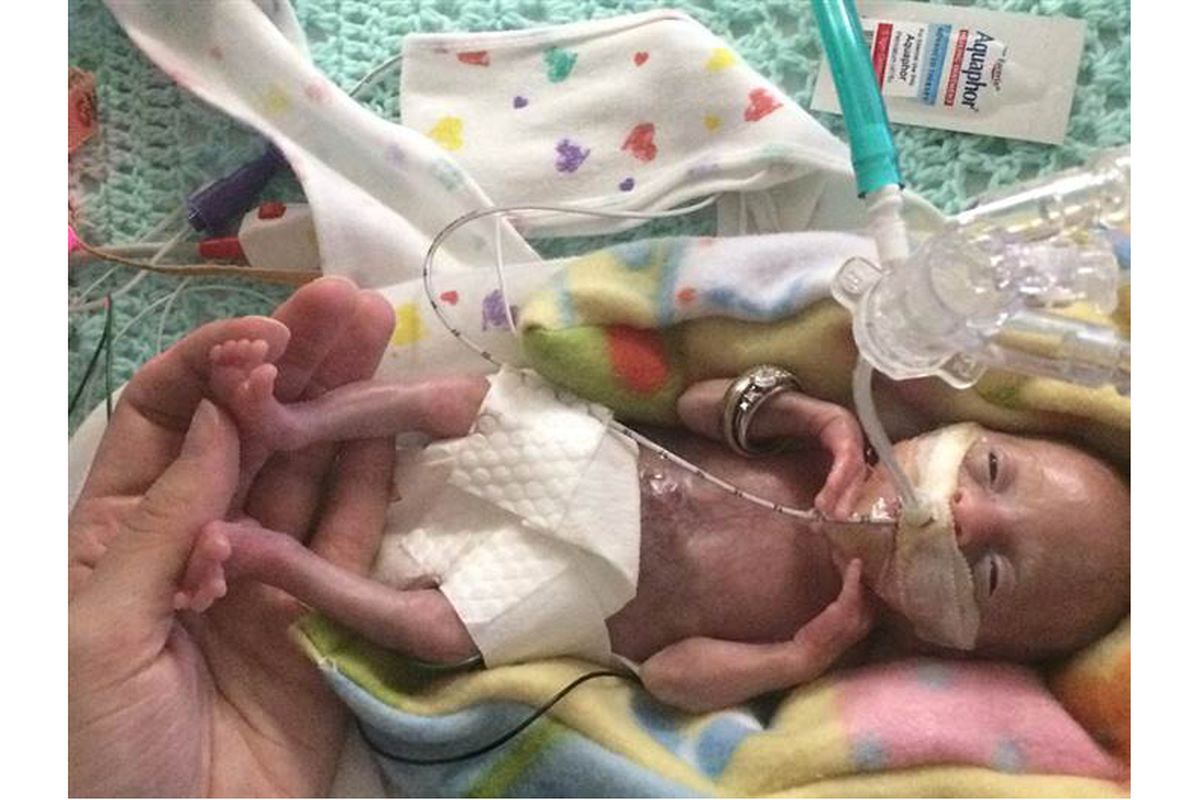 Putri Courtney Stensrud ketika baru lahir. Bayi ini adalah bayi paling prematur di dunia yang masih hidup hingga sekarang.