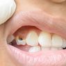 6 Cara Mencegah Penumpukan Plak Gigi yang Bisa Sebabkan Gigi Berlubang