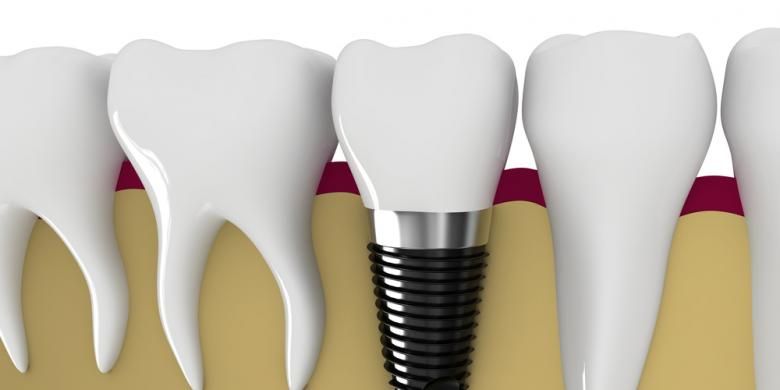 Implan gigi bisa menjadi pilihan yang lebih nyaman dibanding gigi palsu lepasan. 