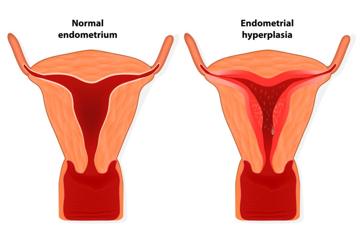 Ilustrasi hiperplasia endometrium