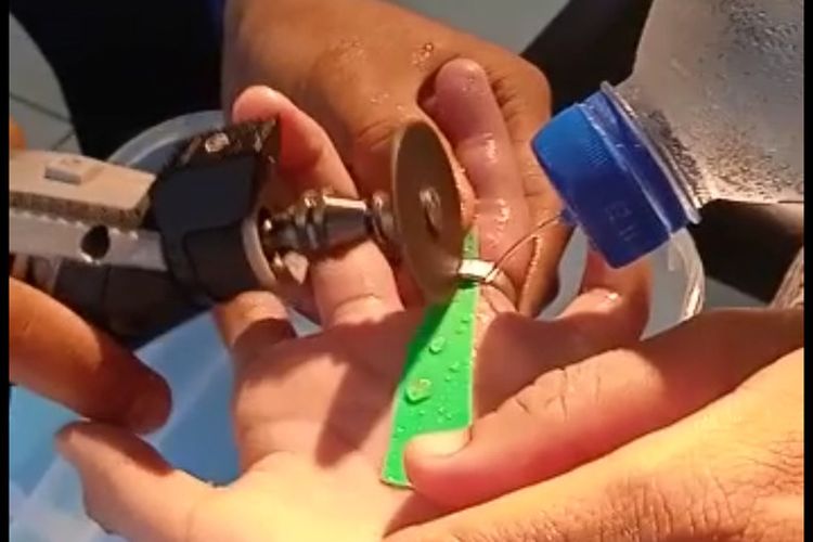 Petugas Damkar Ciamis bekerja sama mengeluarkan cincin yang terjebak di jari manis korban di ruang rawat RSUD Ciamis, Sabtu (8/1/2022). Petugas menggunakan alat mini grinder dan air dingin untuk mencopot cincin.