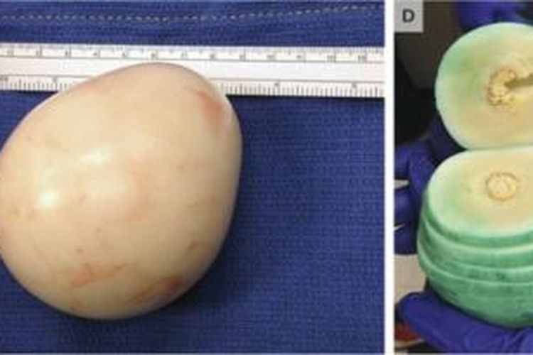 Gumpalan seperti telur rebus atau dikenal dengan istilah Peritoneal Loose Body ditemukan dalam perut seorang pria berusia berusia 62 tahun seperti dilaporkan dalam New England Journal of Medicine.