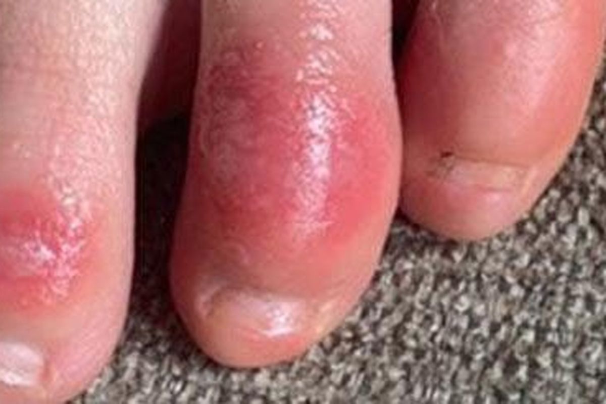 Tangkapan layar adanya ruam di jari kaki pada pasien Covid-19.