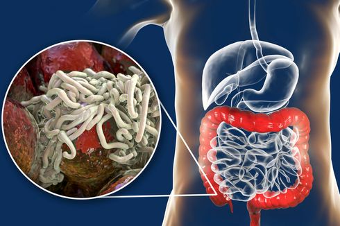 Infeksi Cacing Kremi Bisa Sebabkan Komplikasi, Apa Saja?