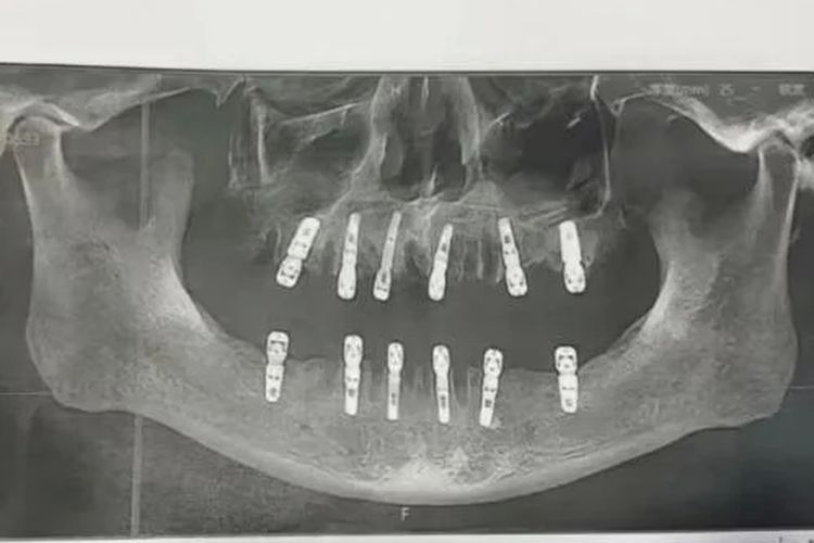 Pria di China Meninggal Dunia Usai Cabut 23 Gigi dalam Sehari, Berikut Penjelasan Dokter