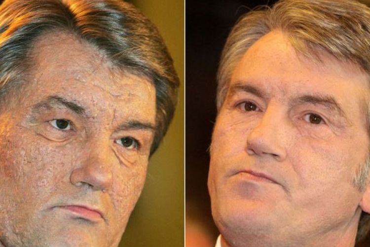 Mantan Presiden Ukraina periode 2005-2010 Viktor Yushchenko. Foto kiri adalah penampilan Yushchenko di 2005 setelah dia pulih dari usaha peracunan terhadap dirinya pada 2004. Kanan adalah penampilan Yushchenko saat 2015.