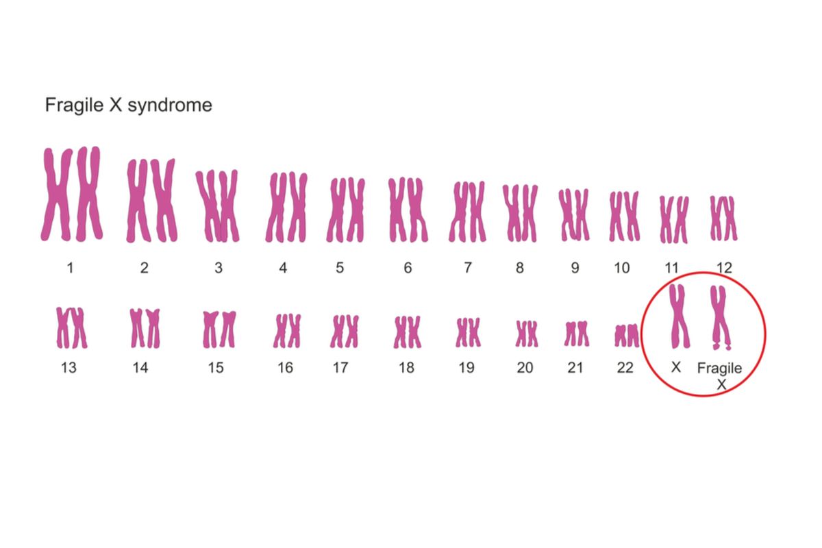 Ilustrasi sindrom fragile x