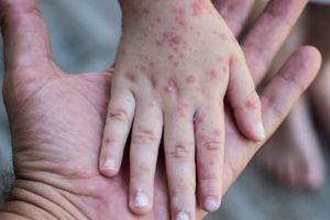 WHO Umumkan Mpox sebagai Darurat Kesehatan Global