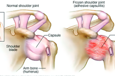 Frozen Shoulder