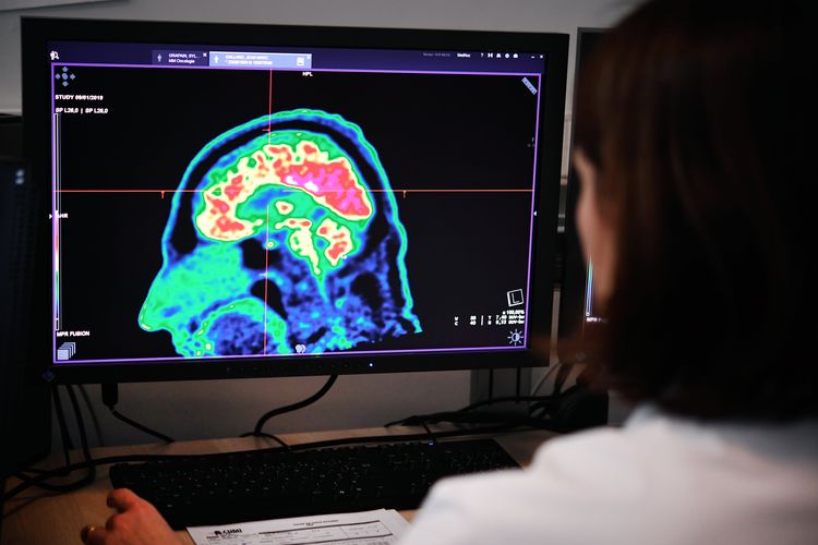 An image of a human brain taken by a positron emission tomography scan, also called a PET scan, is seen on a screen on January 9, 2019, at the Regional Hospital Center and University of Brest (CRHU - Center for the Hospitalier Régional et Universitaire de Brest), western France.  CHRU from Brest recently acquired a new molecular imaging tool, the most advanced in France at present according to the hospital center, which is capable of detecting deep lesions and especially cancer pathologies, the hospital said on January 9, 2019.