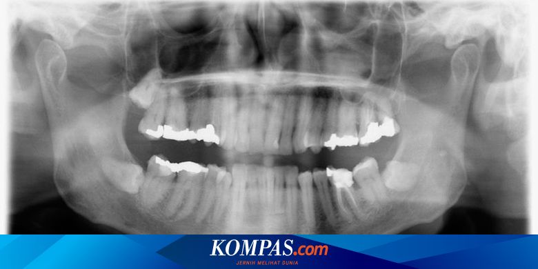 Alasan Dokter Gigi Minta Anda Foto Panoramik Dulu Sebelum Tindakan