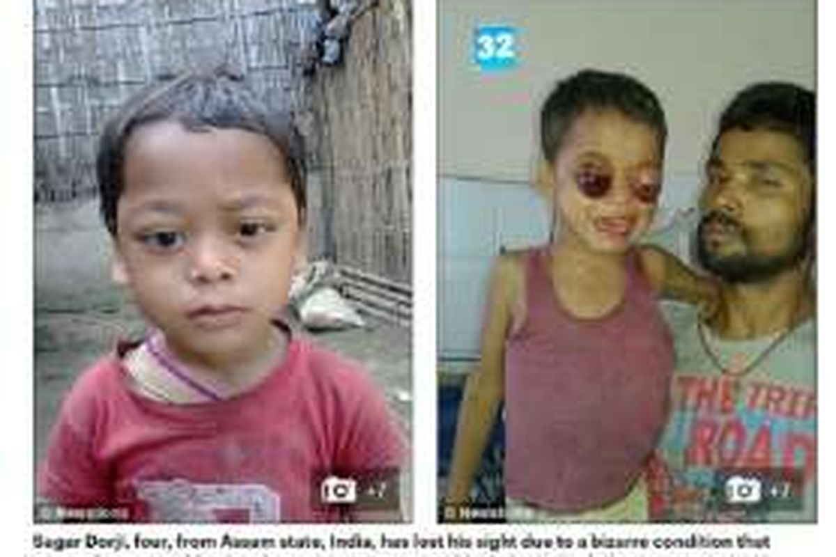 Foto Sagar Dorji (4) saat matanya masih sehat (kiri) dan setelah mengalami kondisi misterius (kanan). 