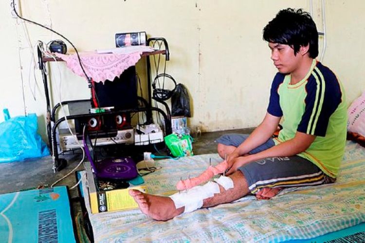 Torang Martua Hutasoit (17), yang kaki kirinya tampak dipasang pen luar, saat menonton televisi di rumahnya di Kecamatan Sidikalang, Kabupaten Dairi, Sumatera Utara, Sabtu (6/5). Sudah 1,5 tahun kakinya tak kunjung sembuh meski sudah empat kali menjalani operasi.