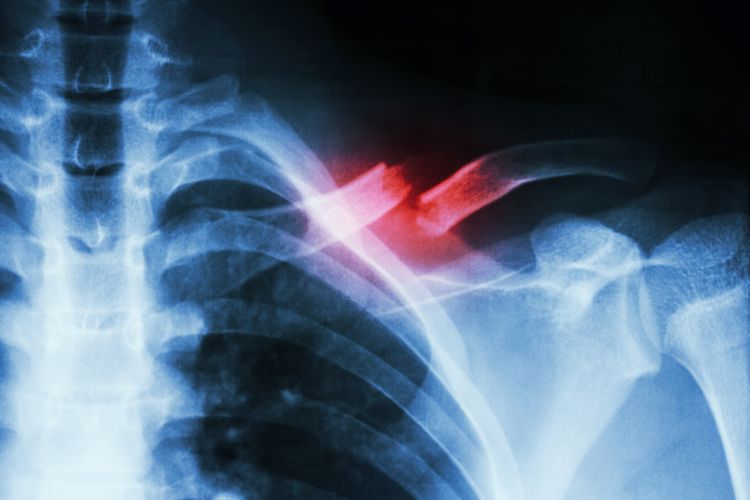 Ilustrasi x-ray patah tulang selangka