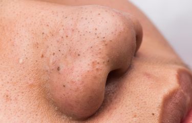 Ilustrasi komedo, penyebab komedo, skincare penghilang komedo. Salah satu manfaat bawang putih untuk wajah adalah menggunakannya untuk mengurangi kemunculan komedo. Cara menghilangkan komedo lainnya juga bisa menggunakan krim retinol secara rutin. 