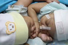 Bayi Kembar Siam Dempet Dada Miliki Kelainan Jantung