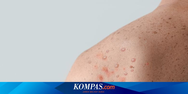 Siasat Pemerintah Cegah Mpox, Publik Diharap Tak Lengah