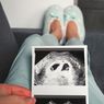 7 Risiko Kehamilan Kembar, Salah Satunya Keguguran
