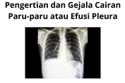 Pengertian dan Gejala Cairan Paru-paru atau Efusi Pleura