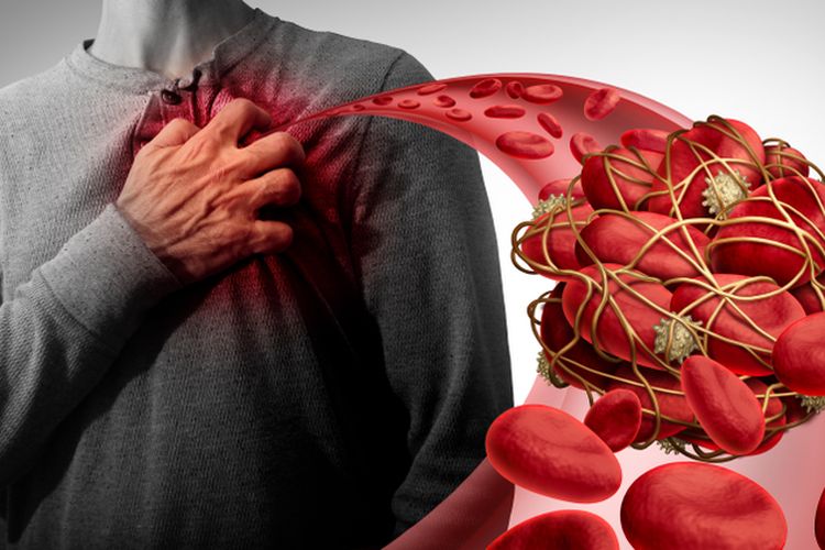 Ilustrasi penggumpalan darah atau trombosis arteri di jantung. Kondisi ini bisa menyebabkan serangan jantung.