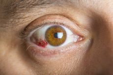 Apakah Mata Berdarah Berbahaya?