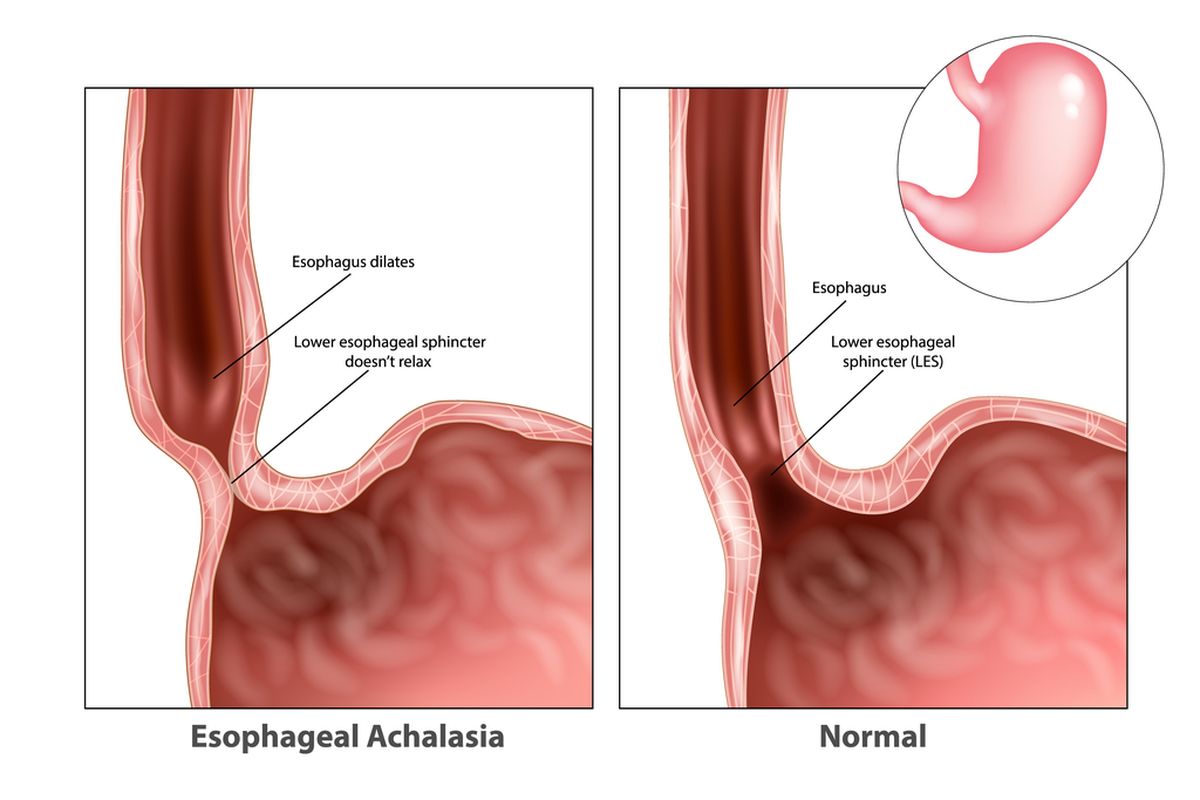 ilustrasi akalasia